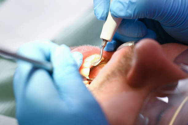 Best Emergency Dentist for Lost Fillings or Crowns in Kapaa, HI